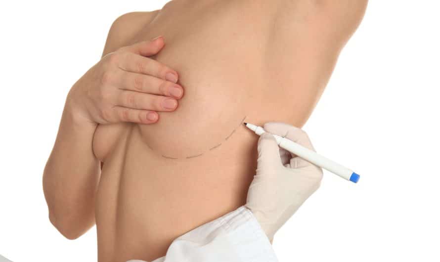 Réduction mammaire : comment traiter l’hypertrophie mammaire féminine
